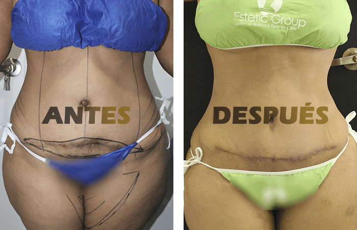 abdominoplastia