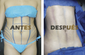 abdominoplastia2