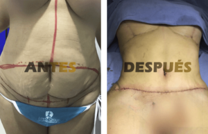 abdominoplastia3