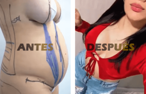 abdominoplastia4