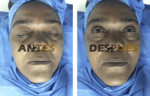 blefaroplastia1