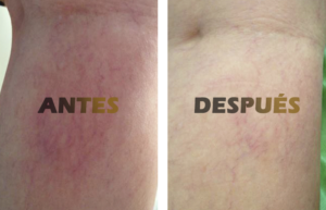 escleroterapia1