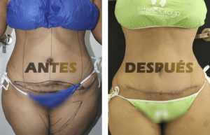 lipodermo2
