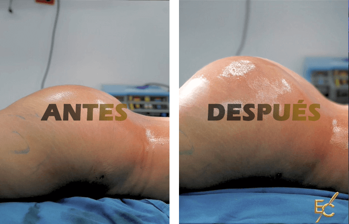 lipogluteos