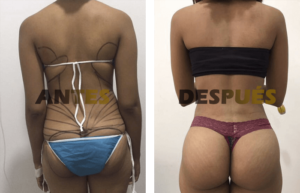 lipogluteos3
