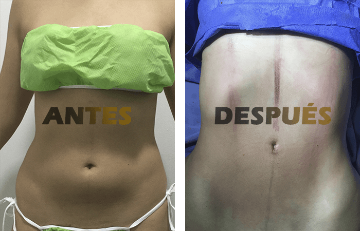 liposuccion2