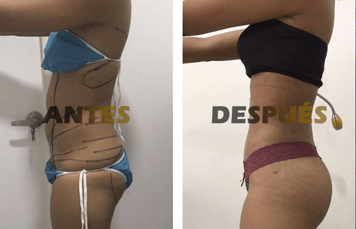 liposuccion3