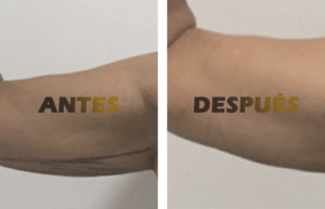 liposuccion_brazos1