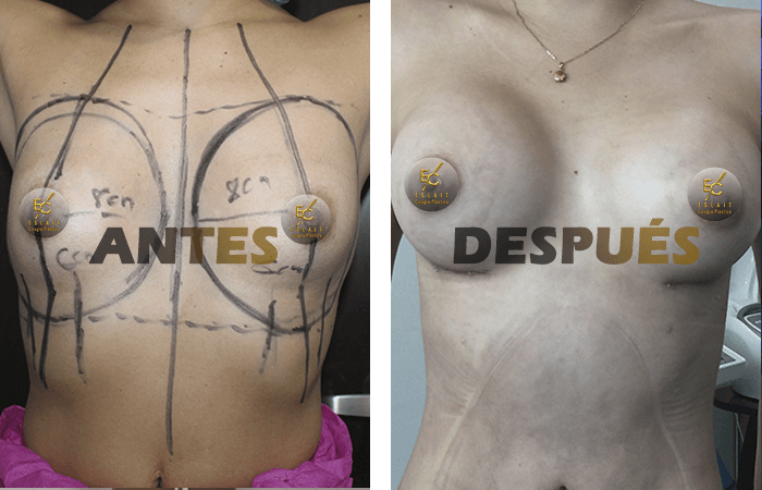 mamoplastia