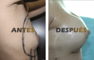 mamoplastia2