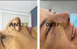 rinoplastia1