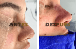 rinoplastia2