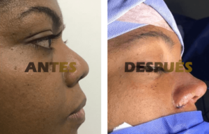 rinoplastia3