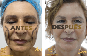 ritidoplastia1