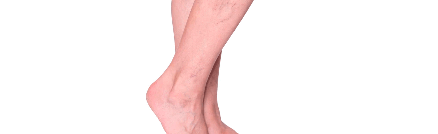 Escleroterapia_eslait