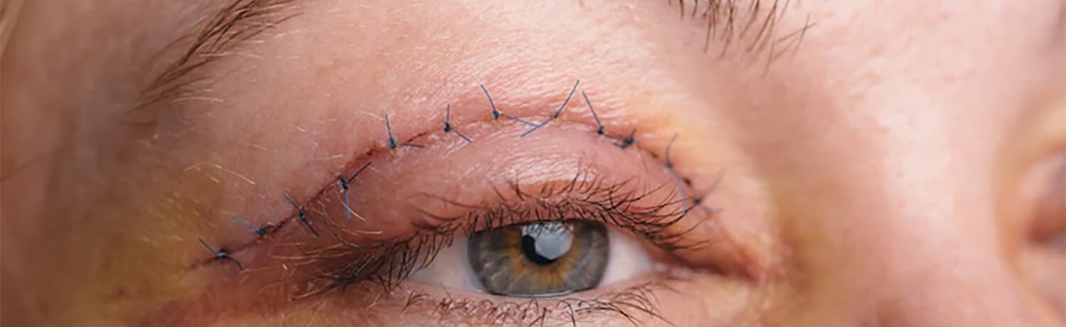 blefaroplastia_eslait