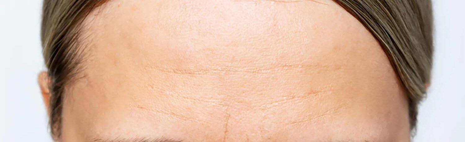 frontoplastia_eslait