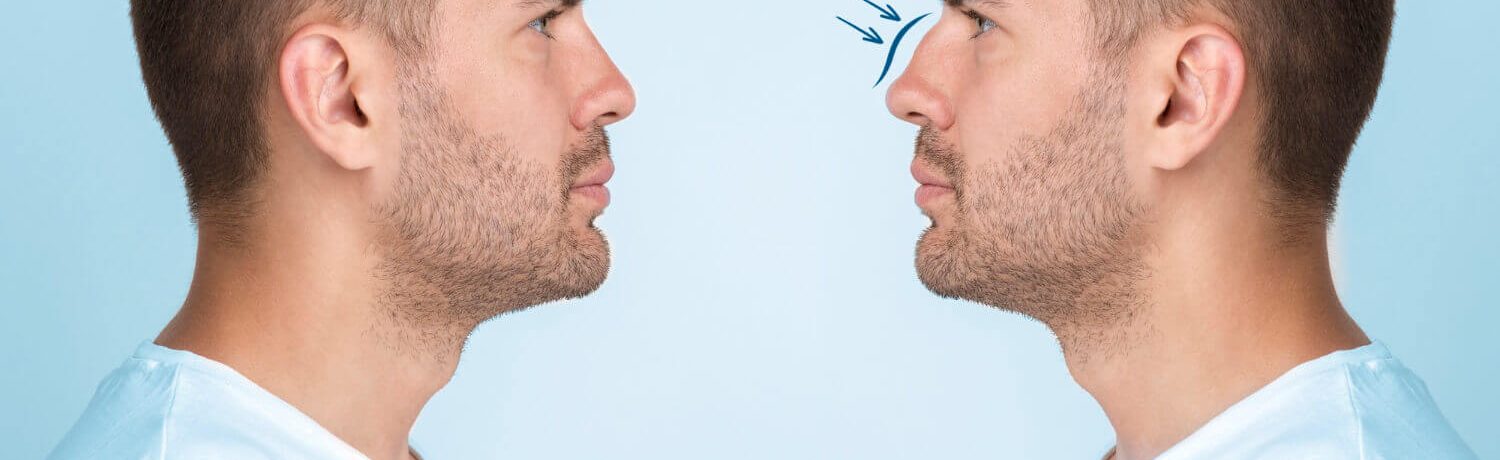 rinoplastia_eslait