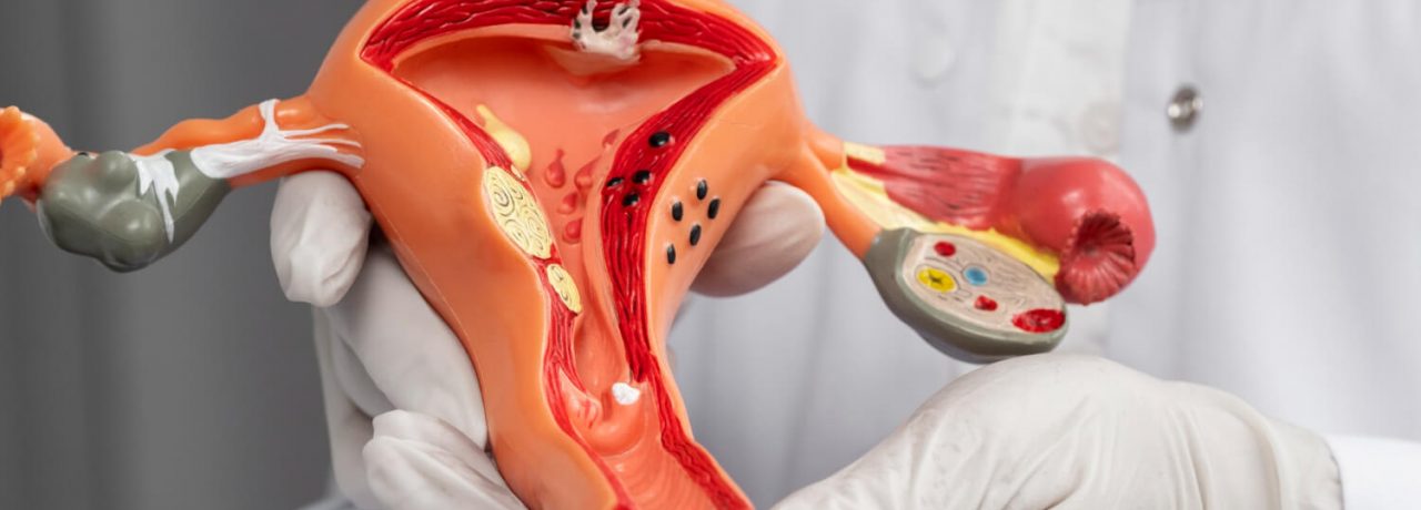 tensado_vaginal_eslait